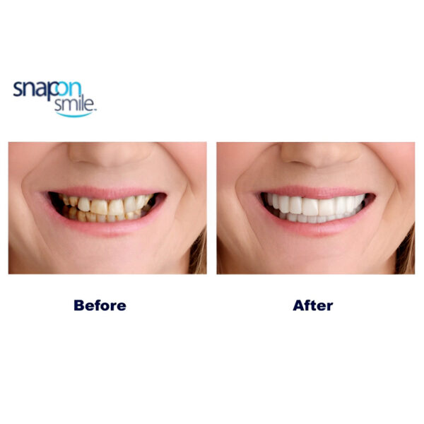 Pack Of 2 Pairs Snap-On Smile Custom Fit Perfect Smile Veneers In 3 Easy Steps before and after