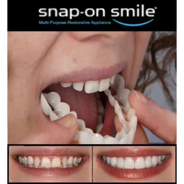 Pairs Snap-On Smile Custom Fit Perfect Smile Veneers In 3 Easy Steps